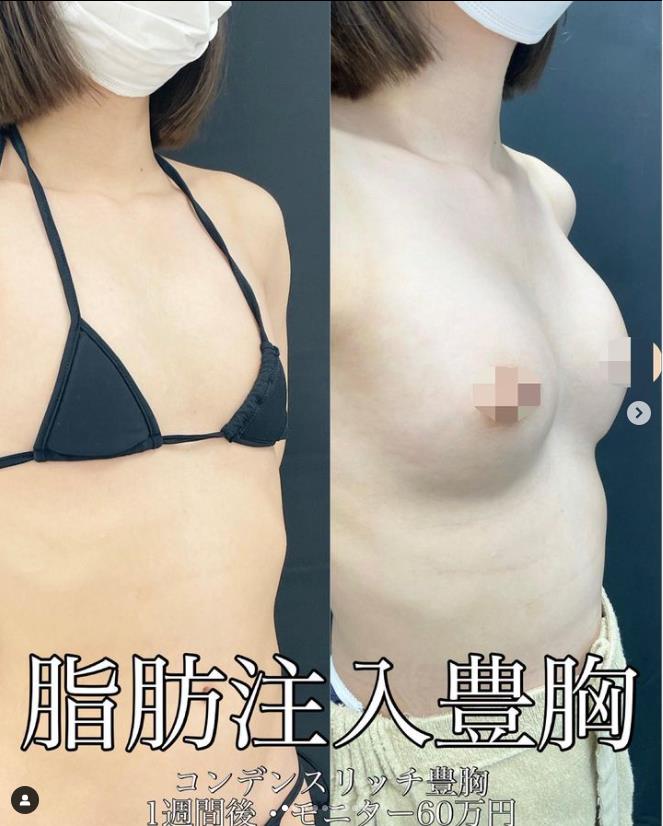 脂肪注入豊胸の症例写真