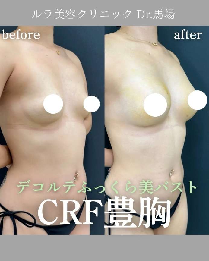 脂肪注入豊胸の症例写真