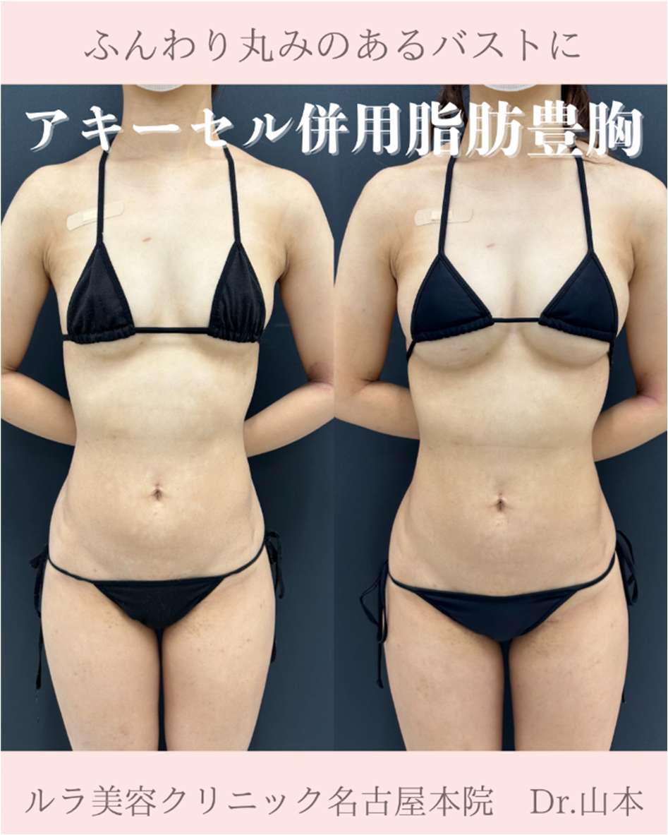 脂肪注入豊胸の症例写真