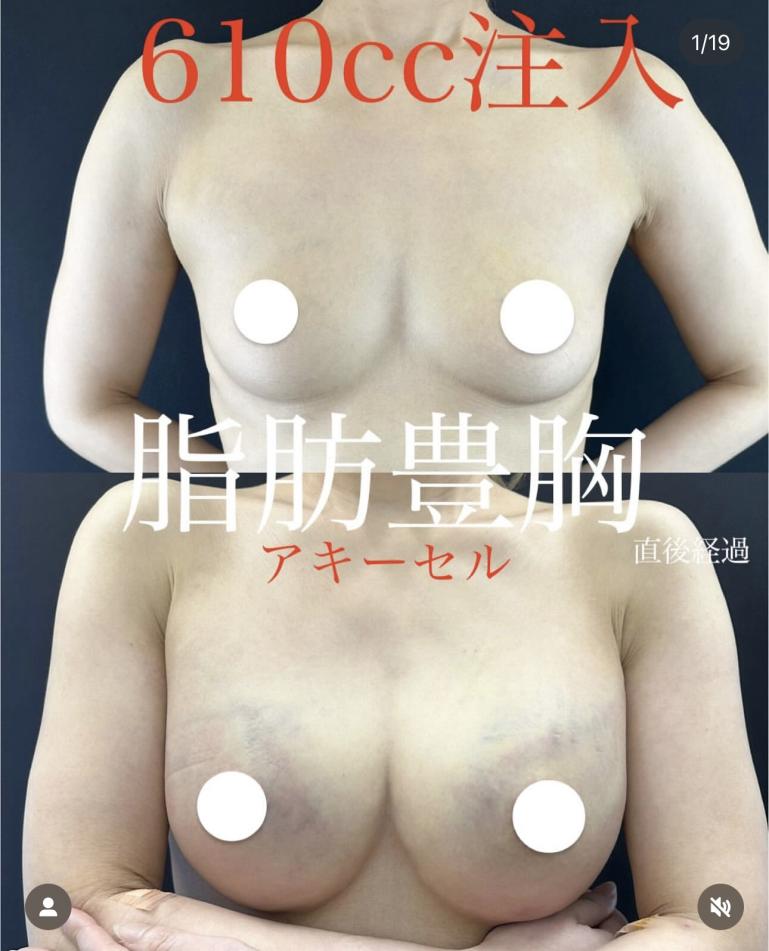 脂肪注入豊胸の症例写真