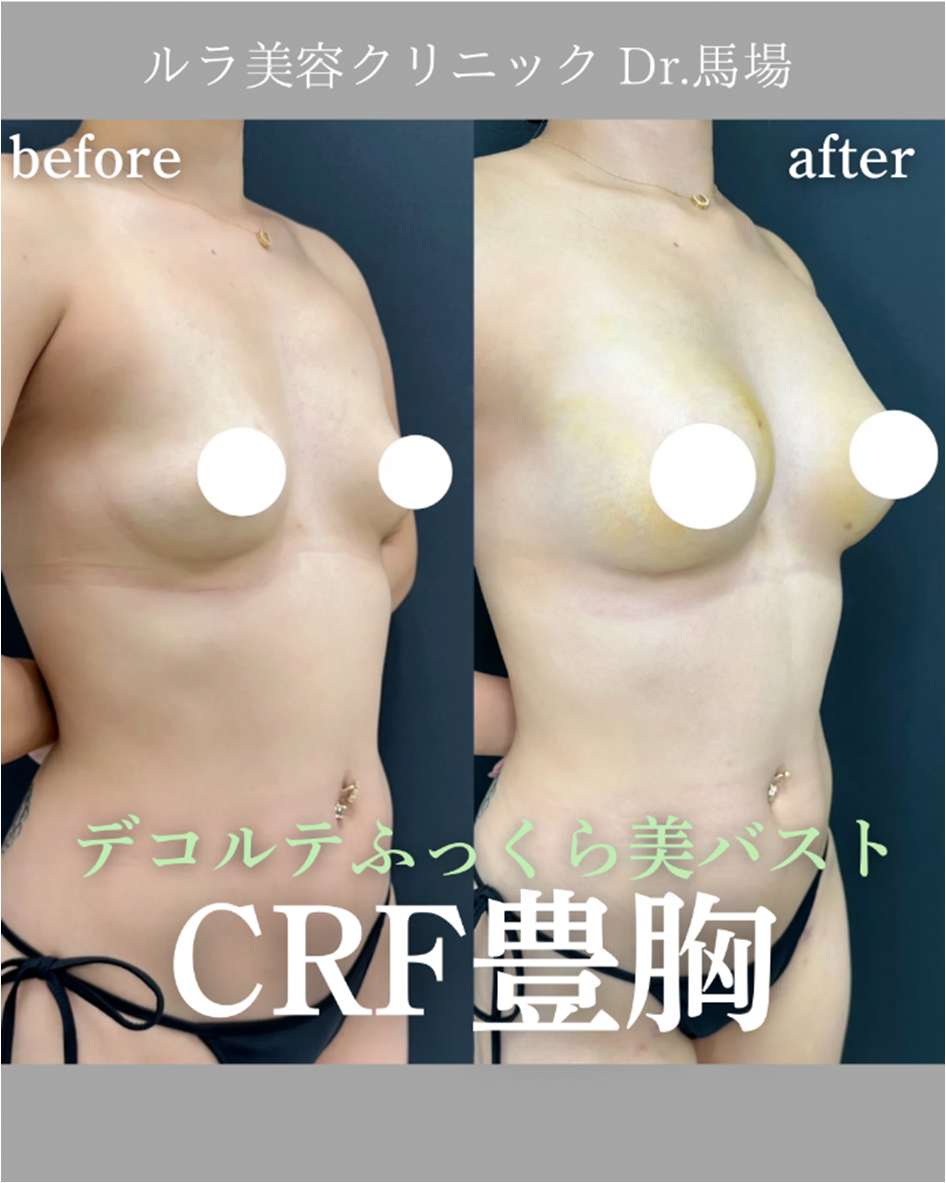 脂肪注入豊胸の症例写真