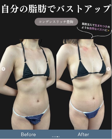 脂肪注入豊胸の症例写真