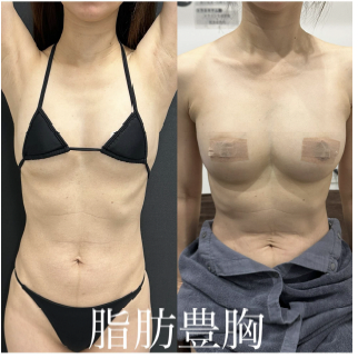 脂肪注入豊胸の症例写真