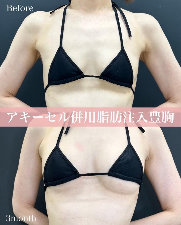 脂肪注入豊胸の症例写真