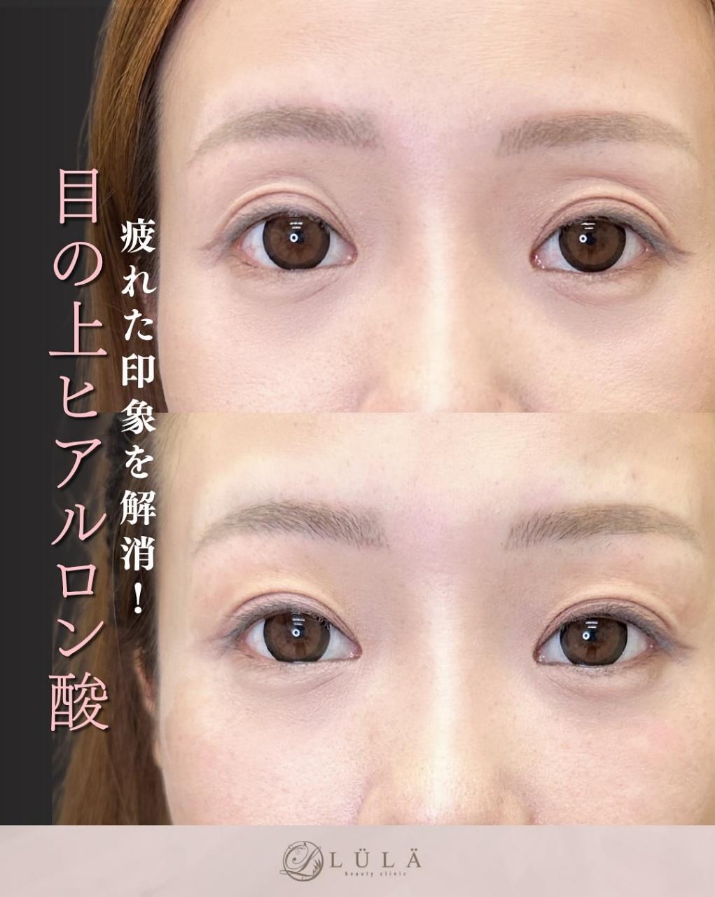 目の上のヒアルロン酸の症例写真