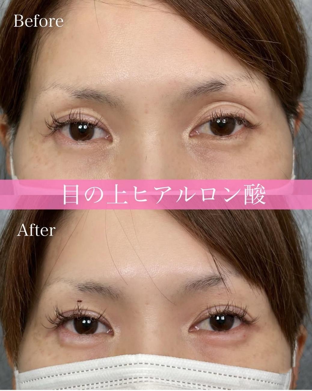 目の上のヒアルロン酸の症例写真