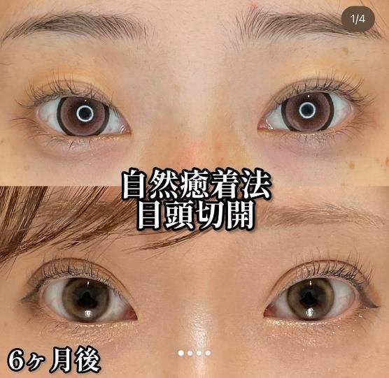 目頭切開法の症例写真