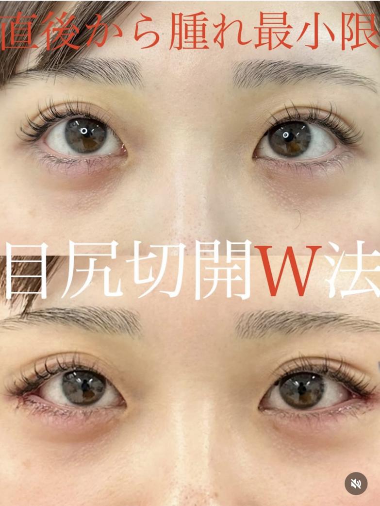 目尻切開法の症例写真
