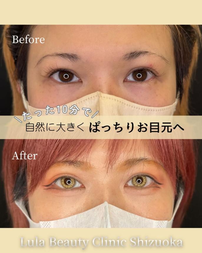 目尻切開法の症例写真