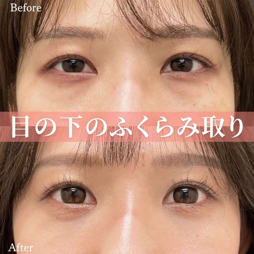 目の下のふくらみ取り