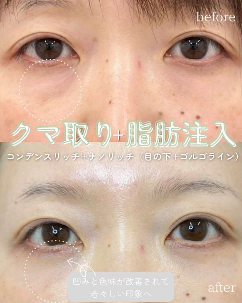 目の下のふくらみ取り