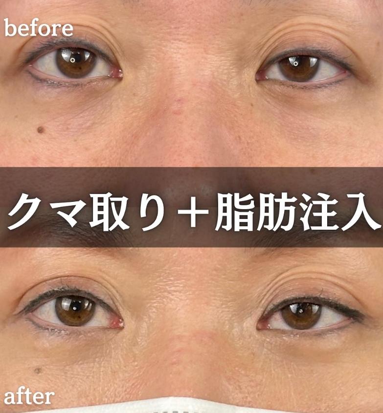 目の下のふくらみ取り