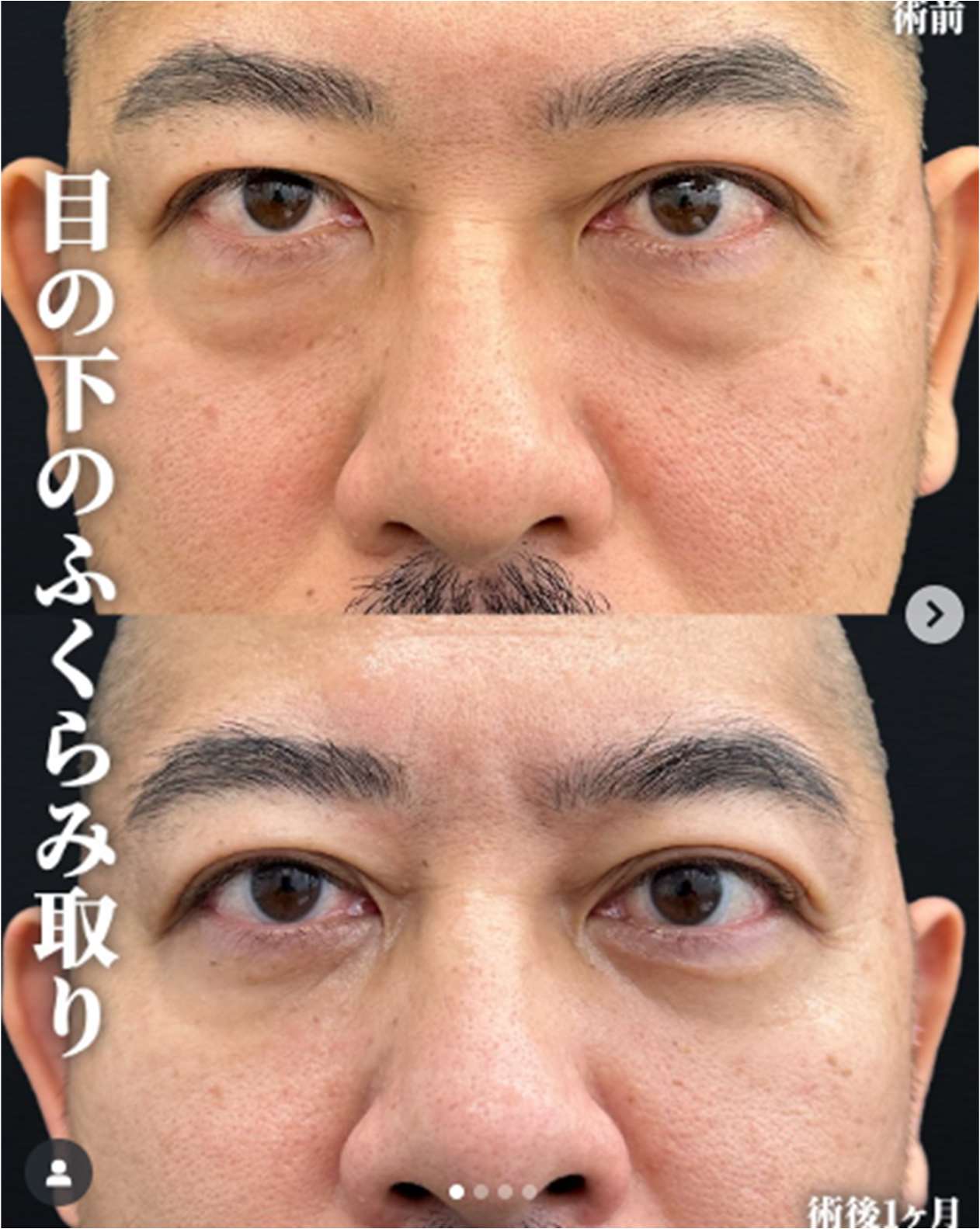 目の下のふくらみ取り