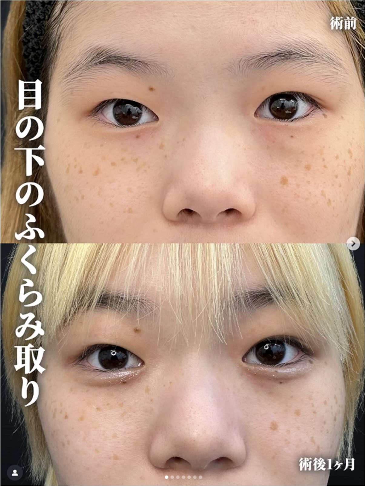 目の下のふくらみ取り