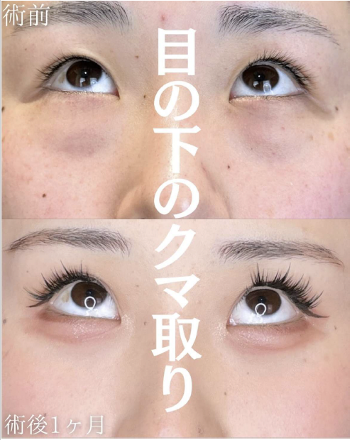 目の下のふくらみ取り