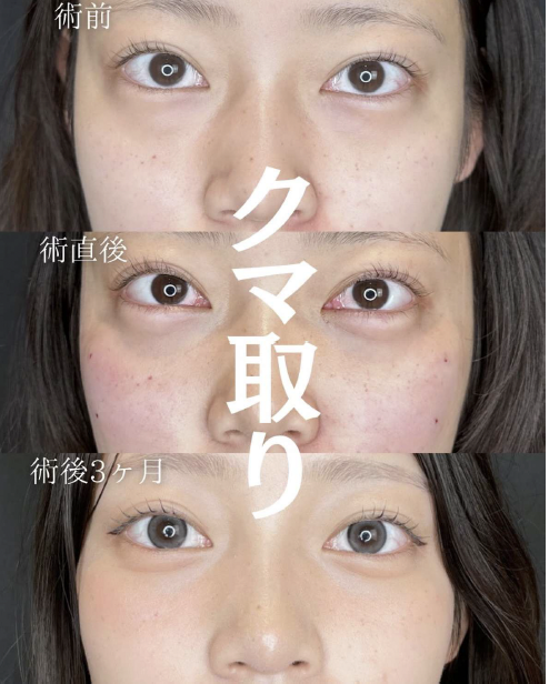目の下のふくらみ取り