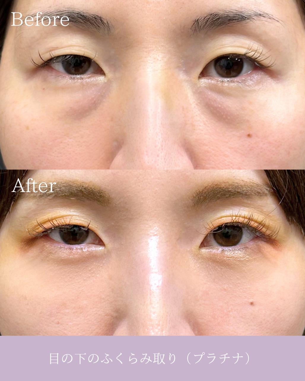 目の下のふくらみ取り