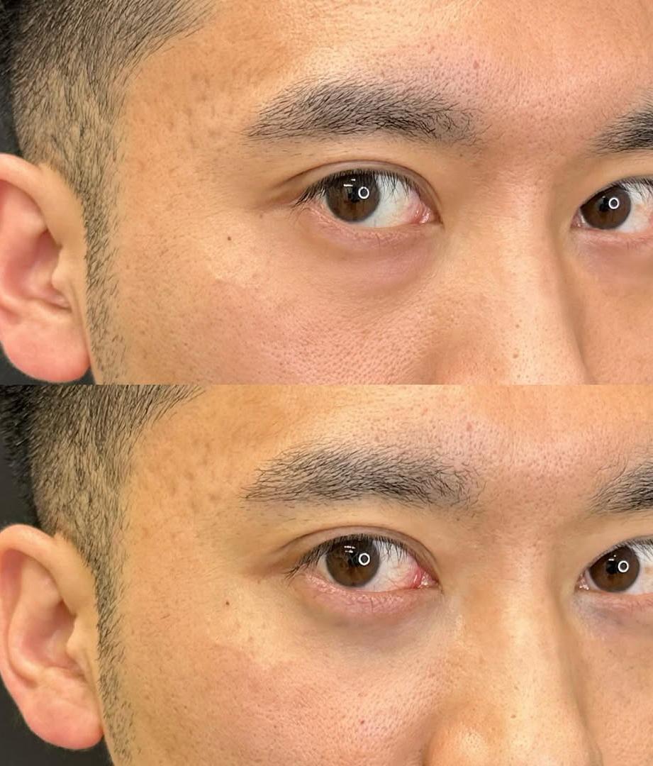 目の下のふくらみ取り