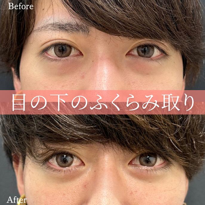目の下のふくらみ取り