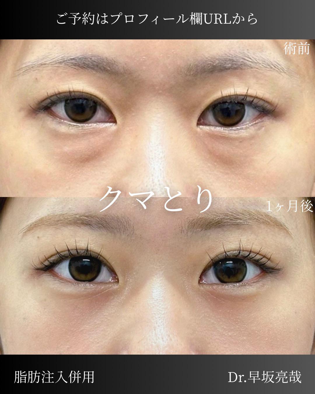 目の下のふくらみ取り