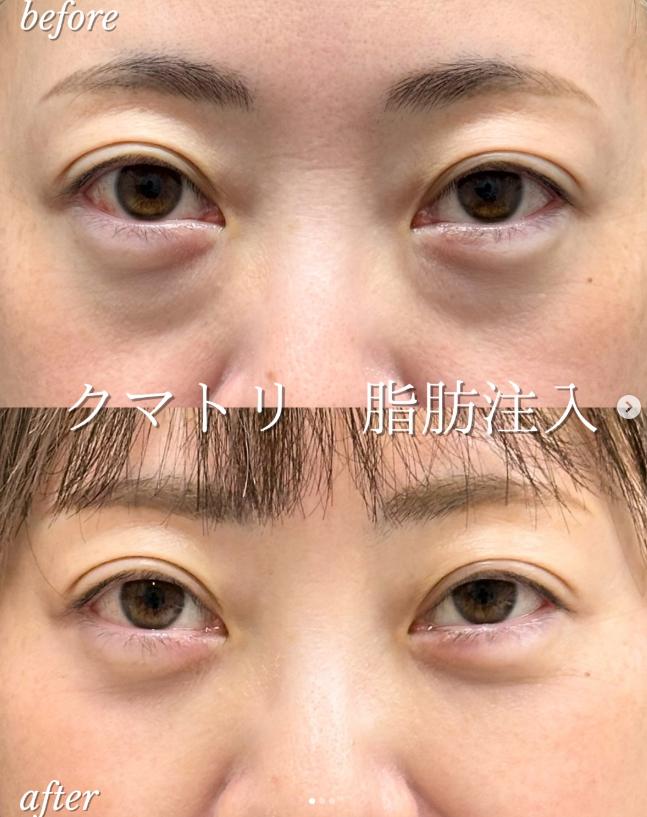 目の下のふくらみ取り