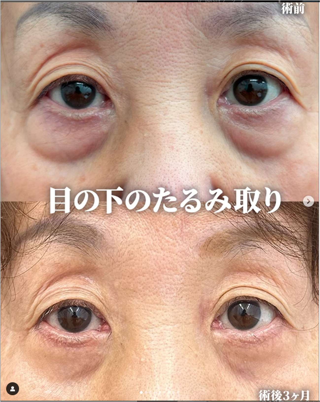 目の下のたるみ取り