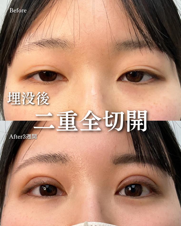 二重全切開の症例写真
