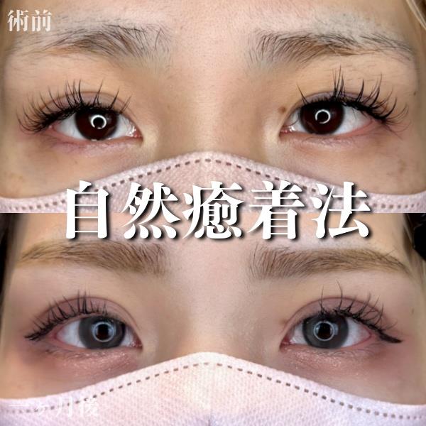 二重埋没
