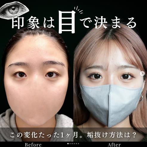 二重埋没