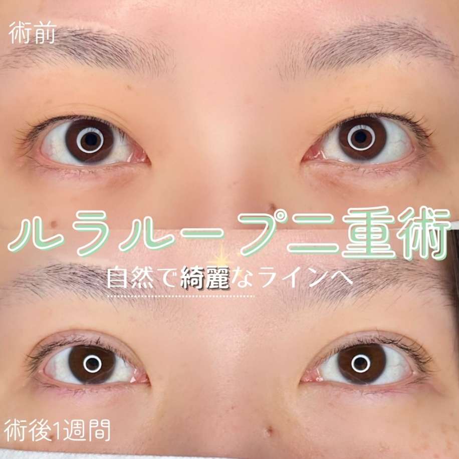 二重埋没