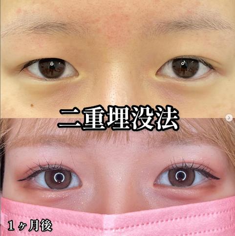 二重埋没