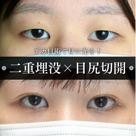二重埋没