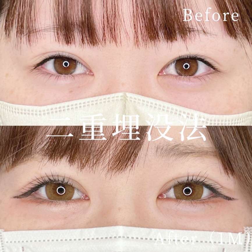 二重埋没