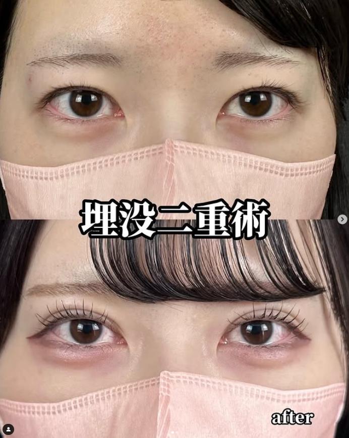 二重埋没