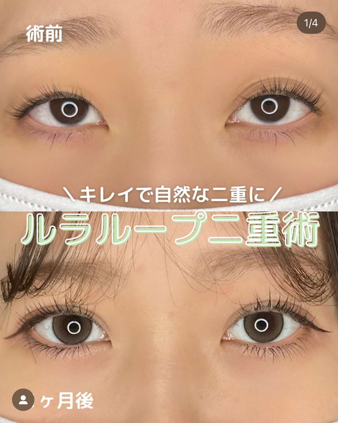 二重埋没