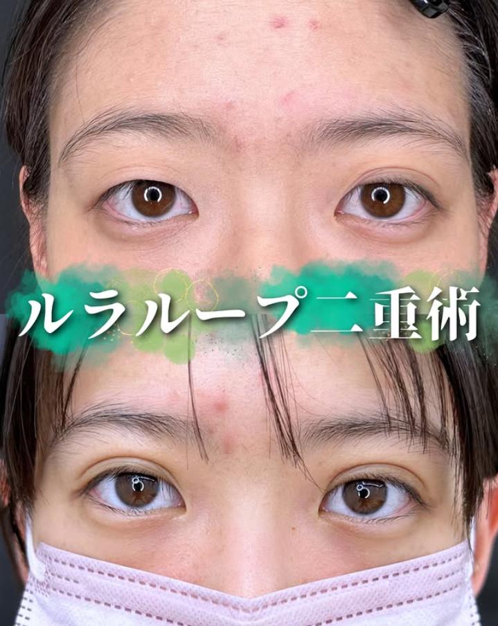 二重埋没