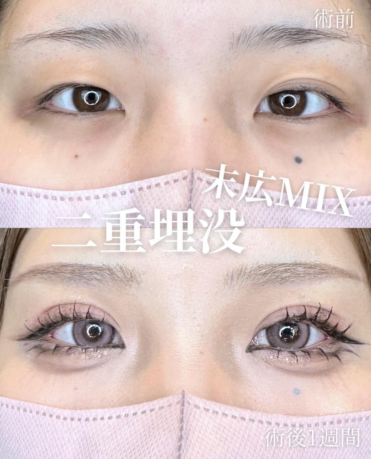 二重埋没
