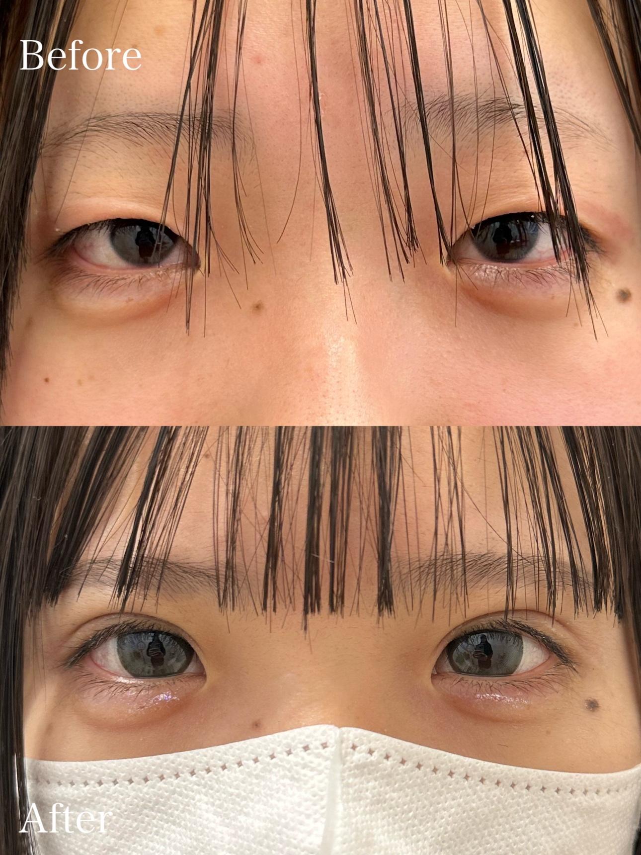 二重埋没