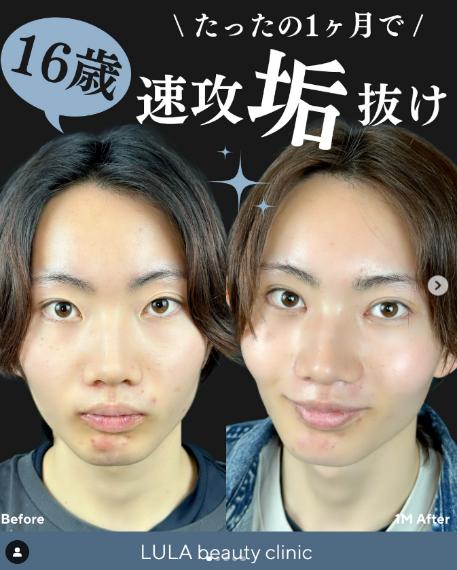 二重埋没