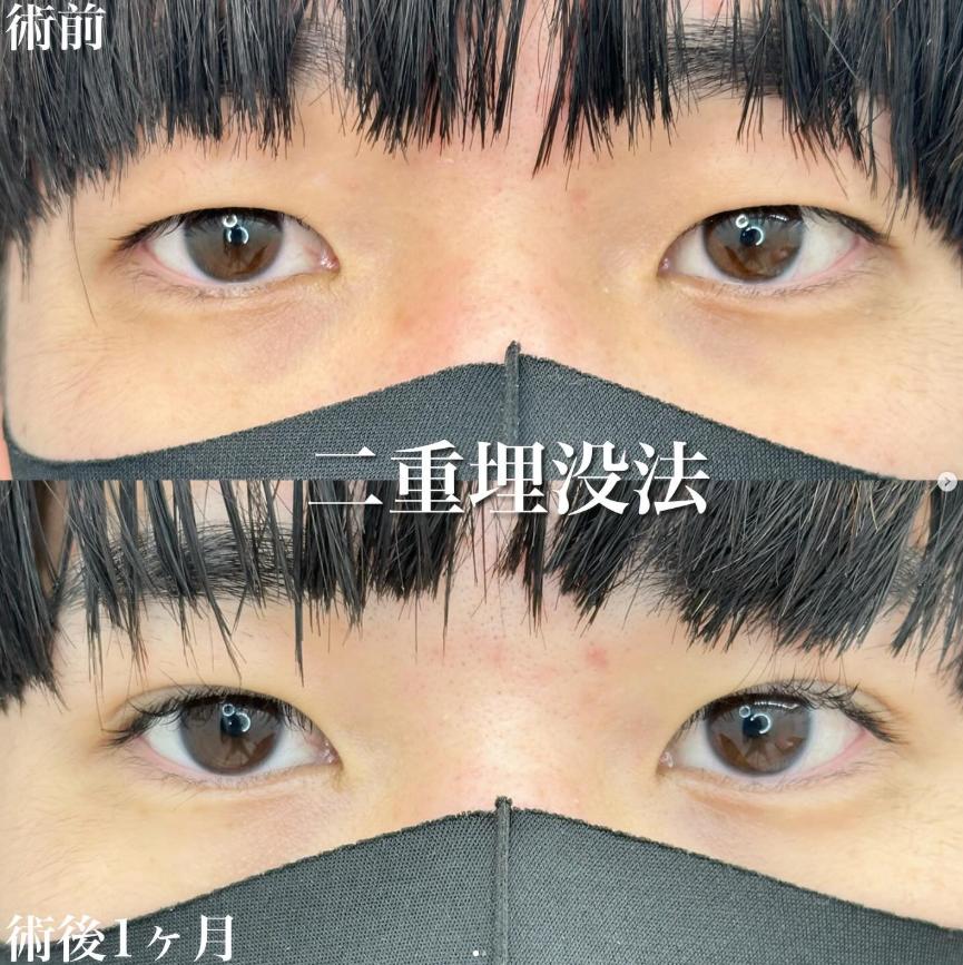 二重埋没