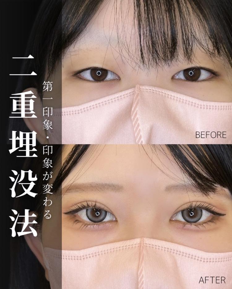 二重埋没