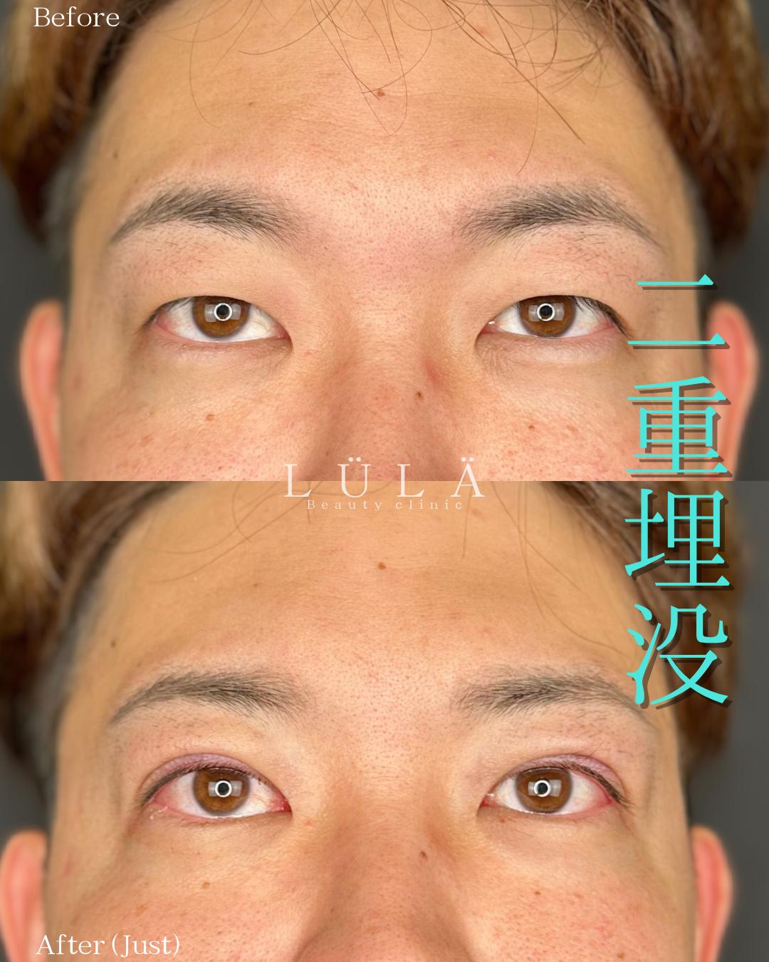 二重埋没