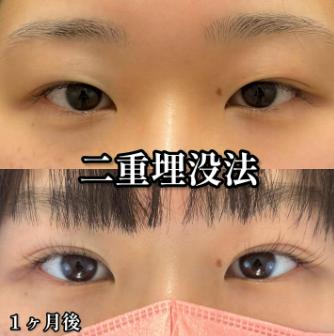 二重埋没