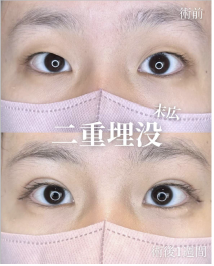 二重埋没