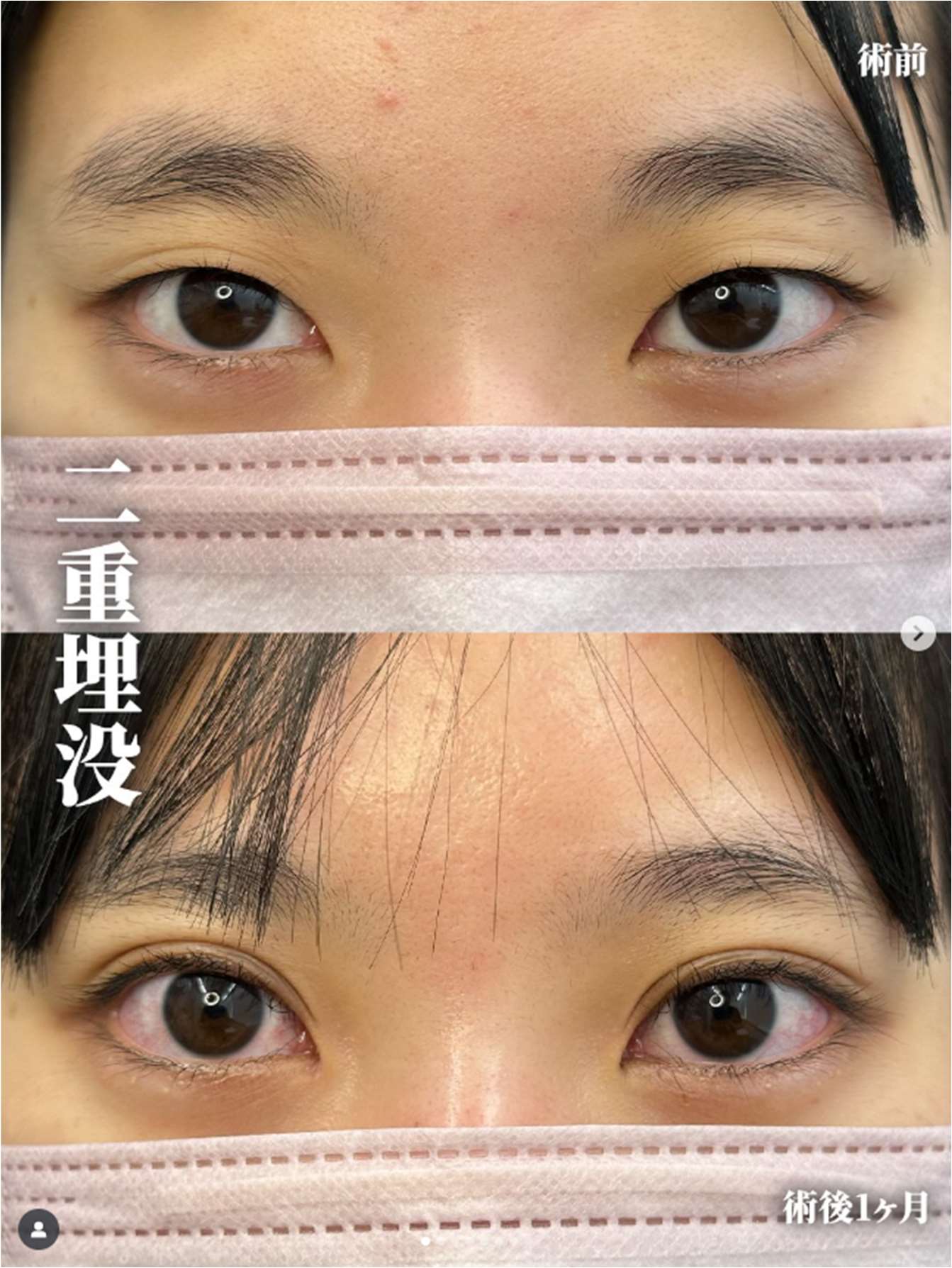 二重埋没