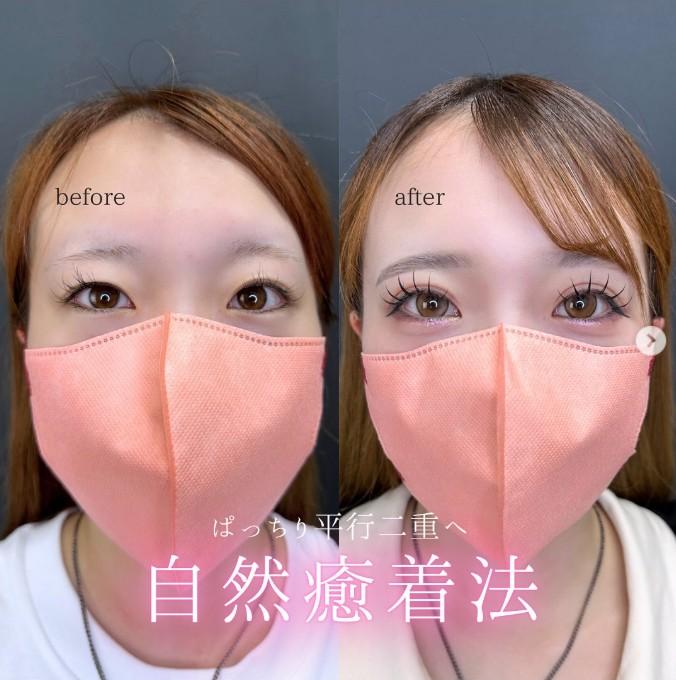 二重埋没