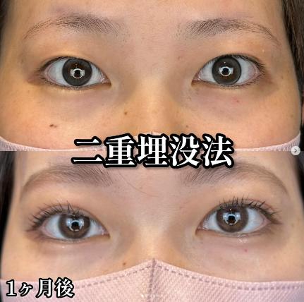 二重埋没