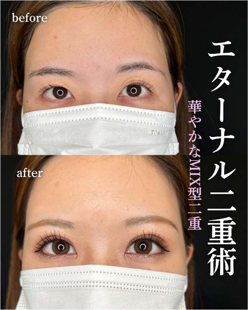 二重埋没