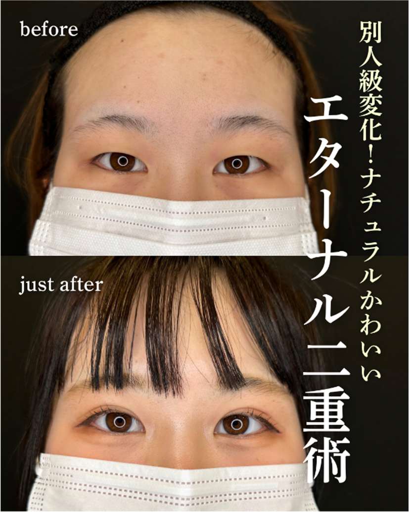二重埋没