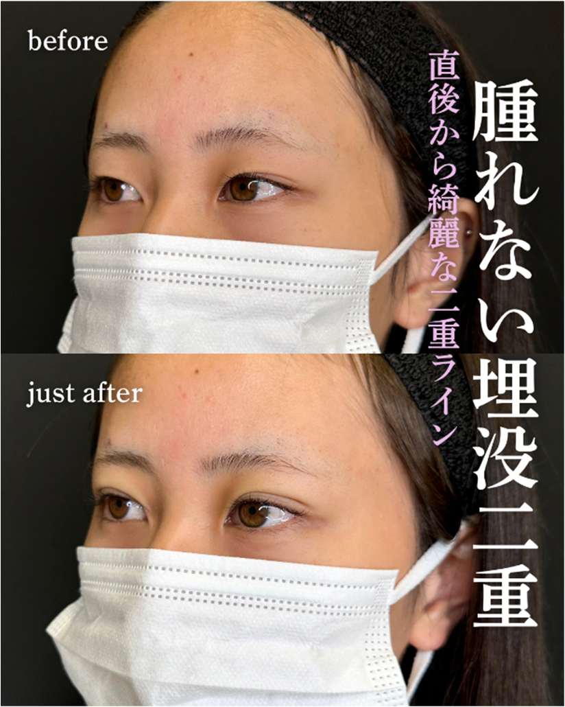 二重埋没